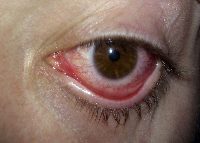 AUGE adern auge blut 