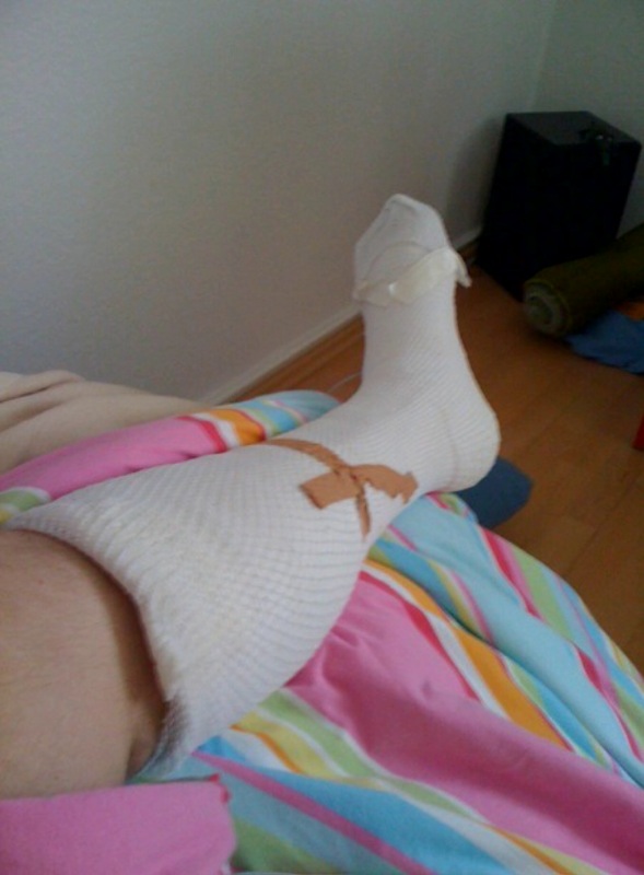 Der gebrochen fuss gips 