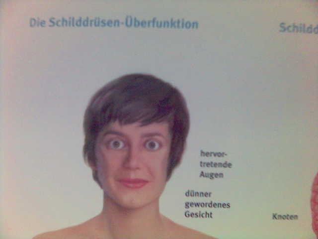 Anschaulich augen gesicht krank krankheit schilddr�se 